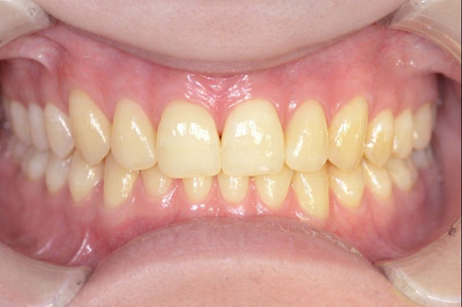 千歳烏山駅の歯医者、しんやデンタルクリニック千歳烏山のホワイトニング症例