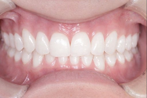 千歳烏山駅の歯医者、しんやデンタルクリニック千歳烏山のホワイトニング症例